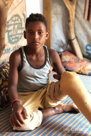 Salah, boy with prosthetic leg in Yemen